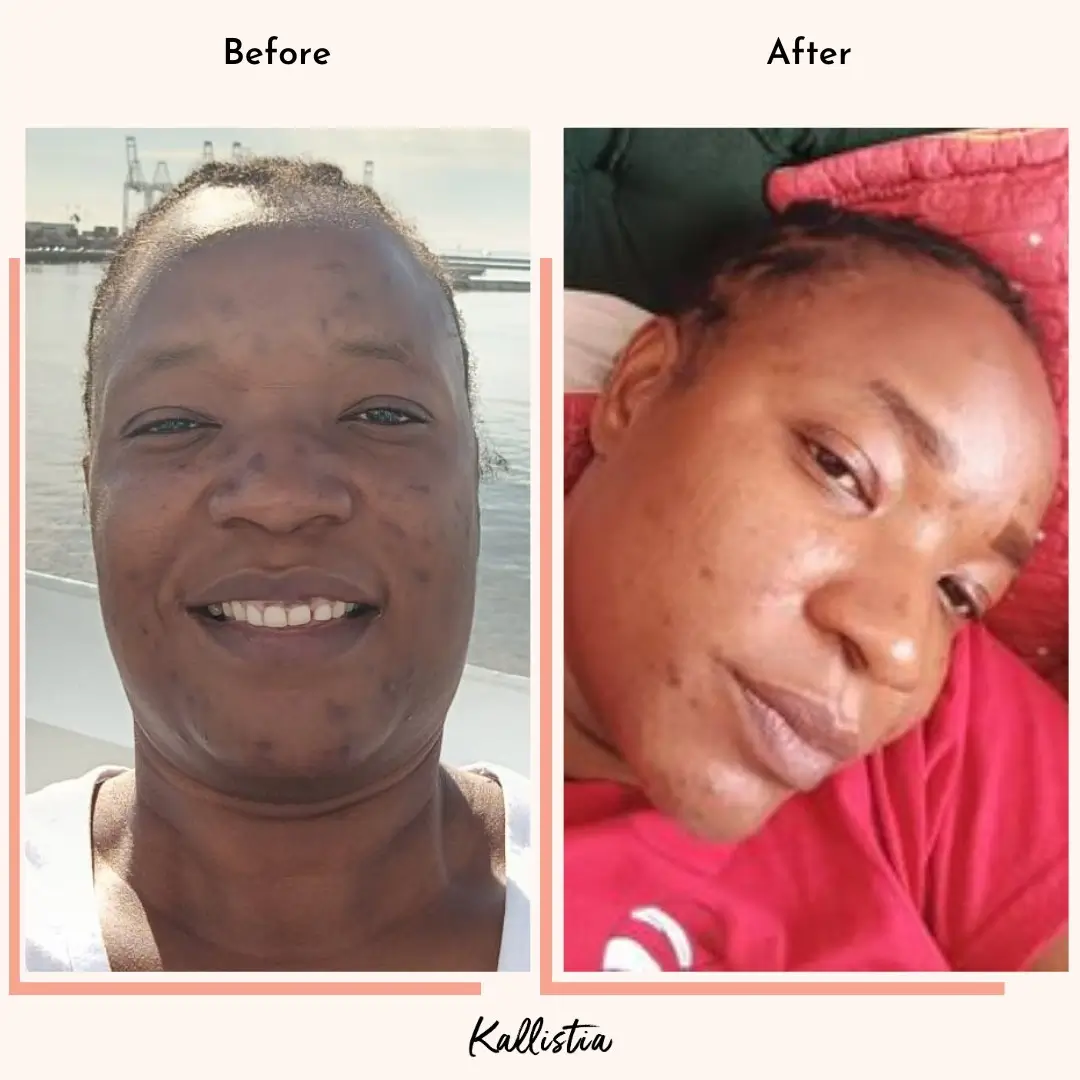 Mai — Acne — after 3 months — before and after