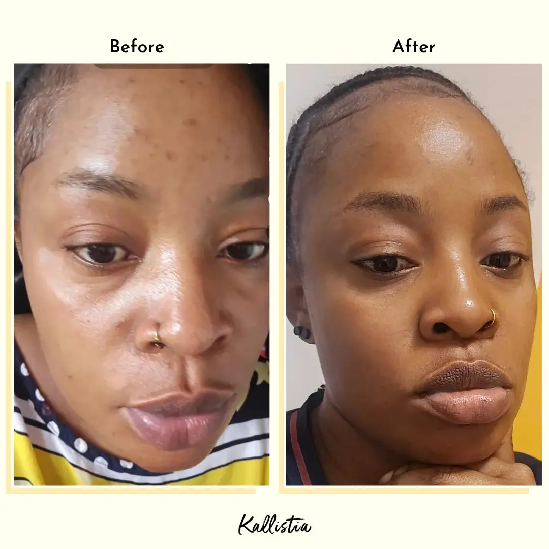 Ruth — Hyperpigmentation — after 45 days — before and after