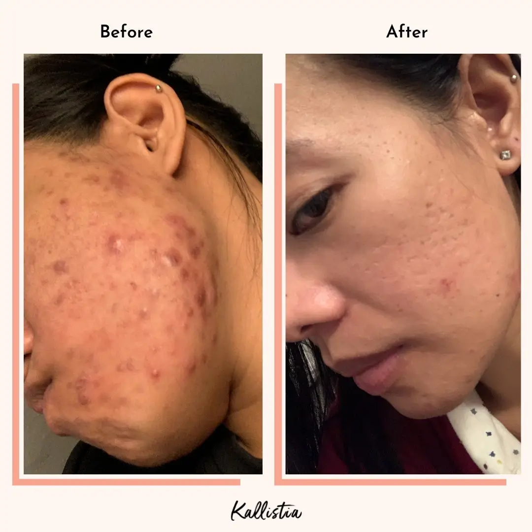Lea — Acne — after 3 months — before and after