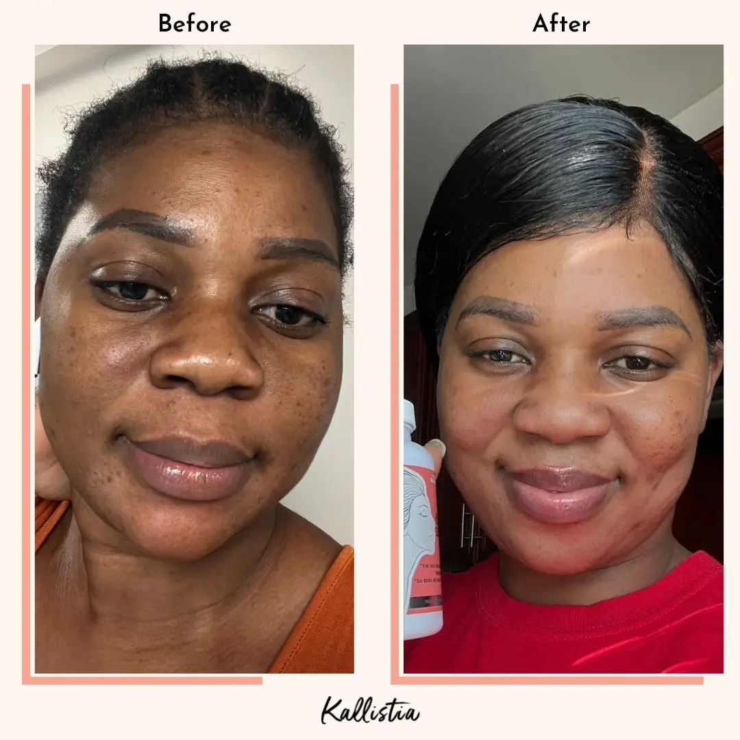 Fatime — Melasma — after 2 months — before and after