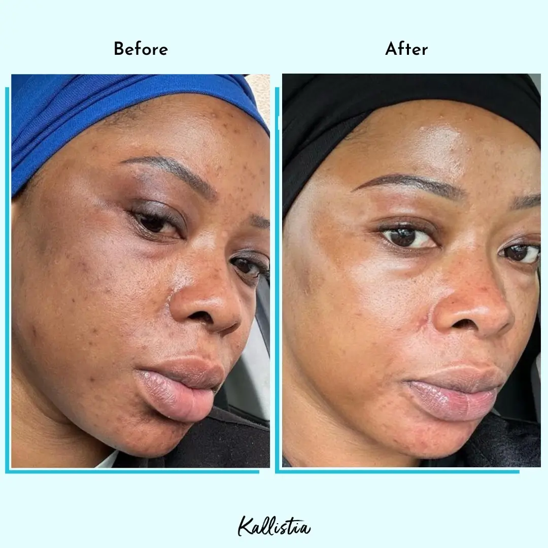 Fatou — Hyperpigmentation — after 3 weeks — before and after