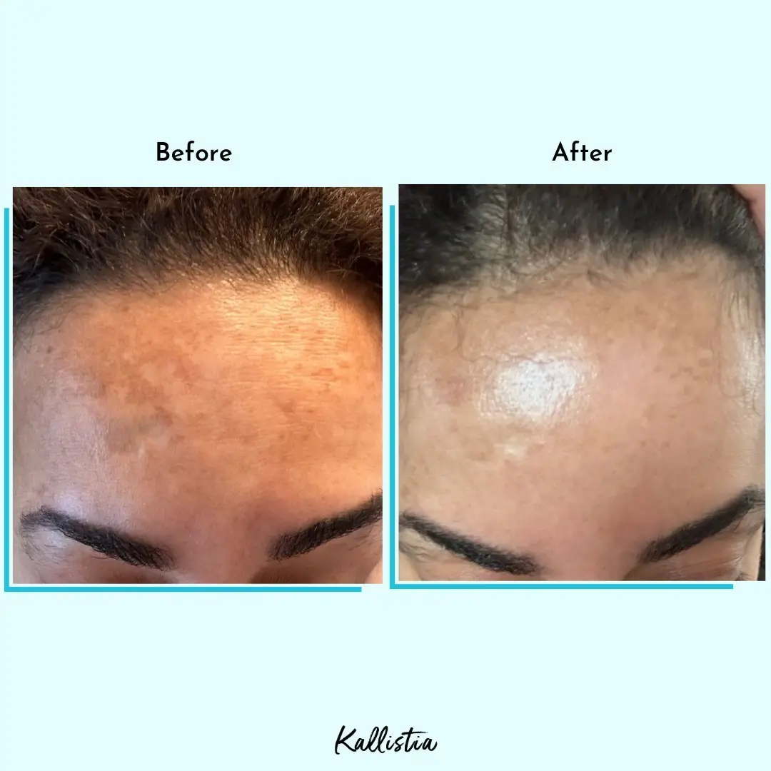 Mila — Hyperpigmentation — after 1 month — before and after