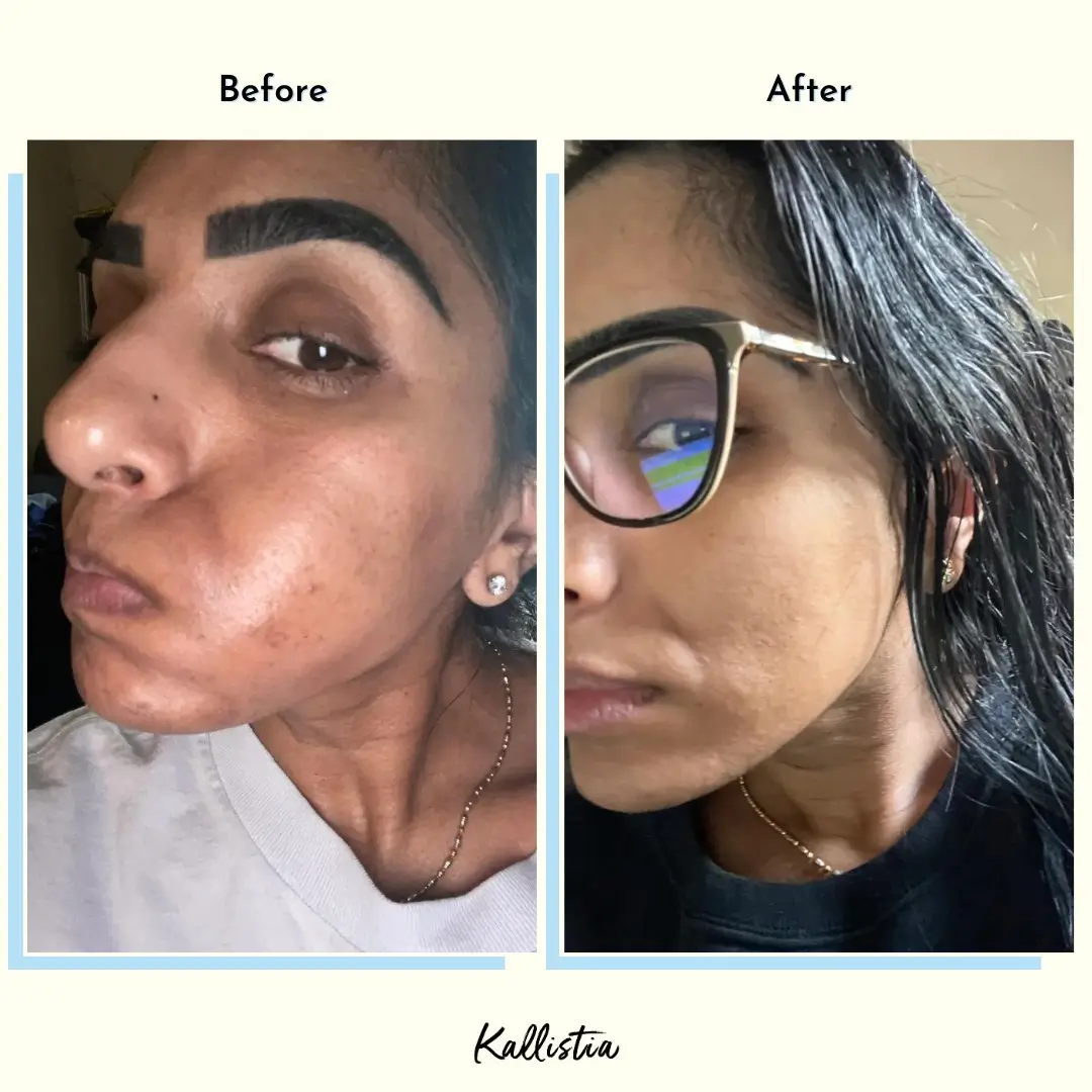 Jasbeendar — Melasma — after 1 month — before and after