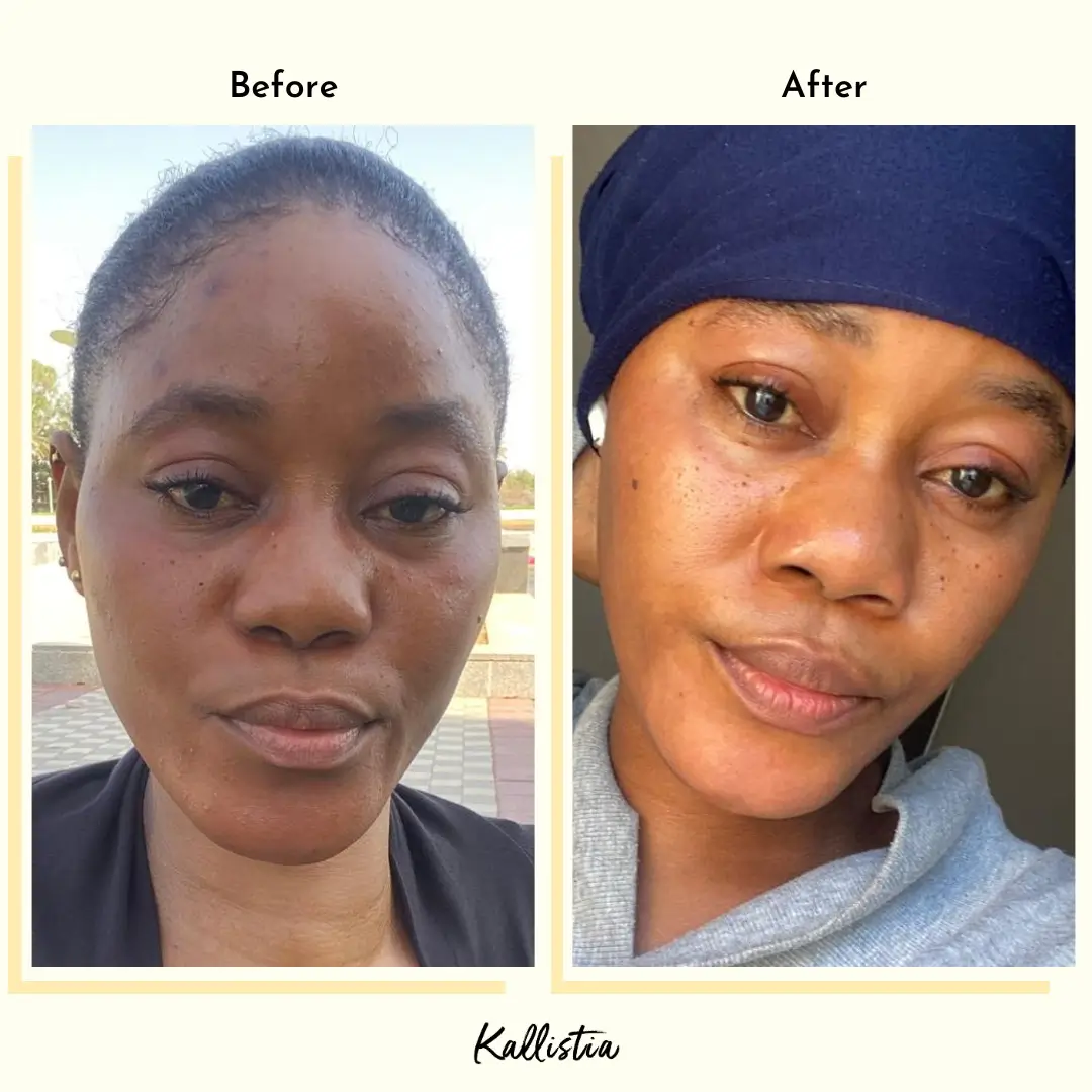 Helena — Hyperpigmentation — after 2 months — before and after