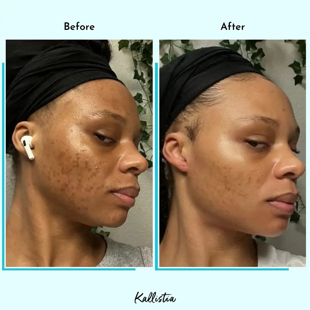 Amira — Post-Acne Marks — after 2 months — before and after