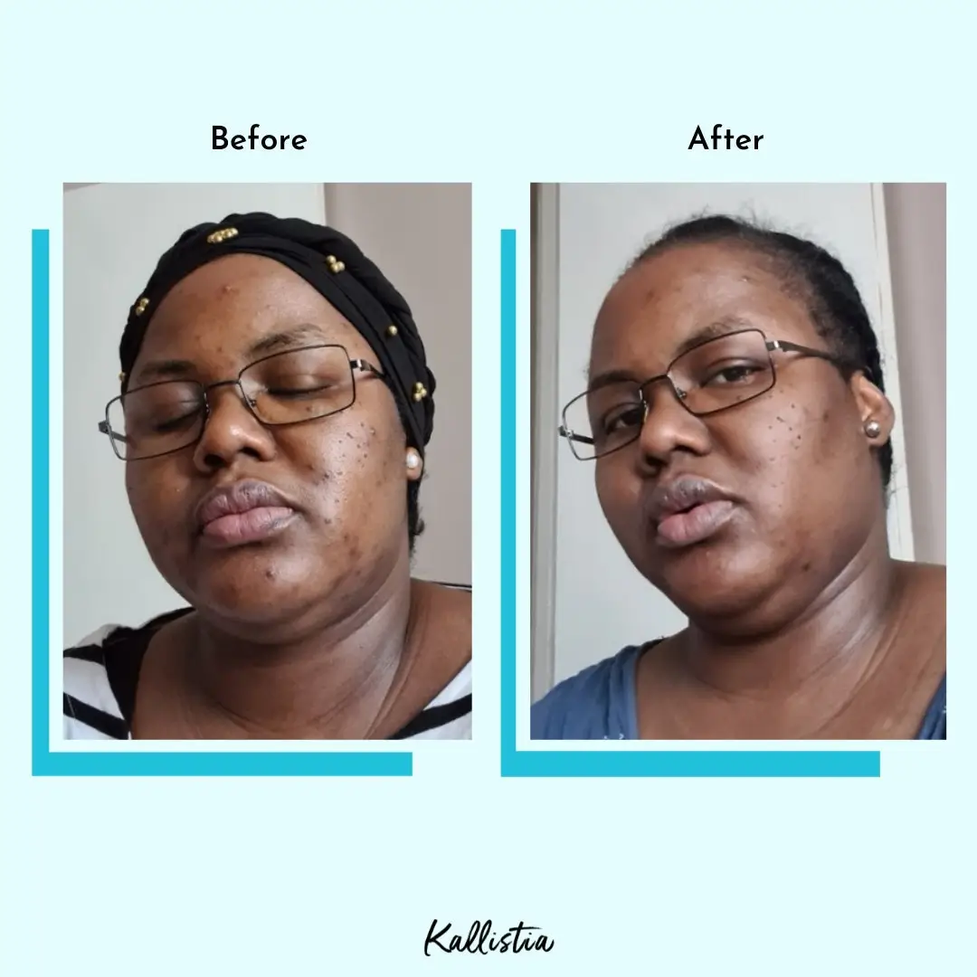 Carine — Hyperpigmentation — after 45 days — before and after