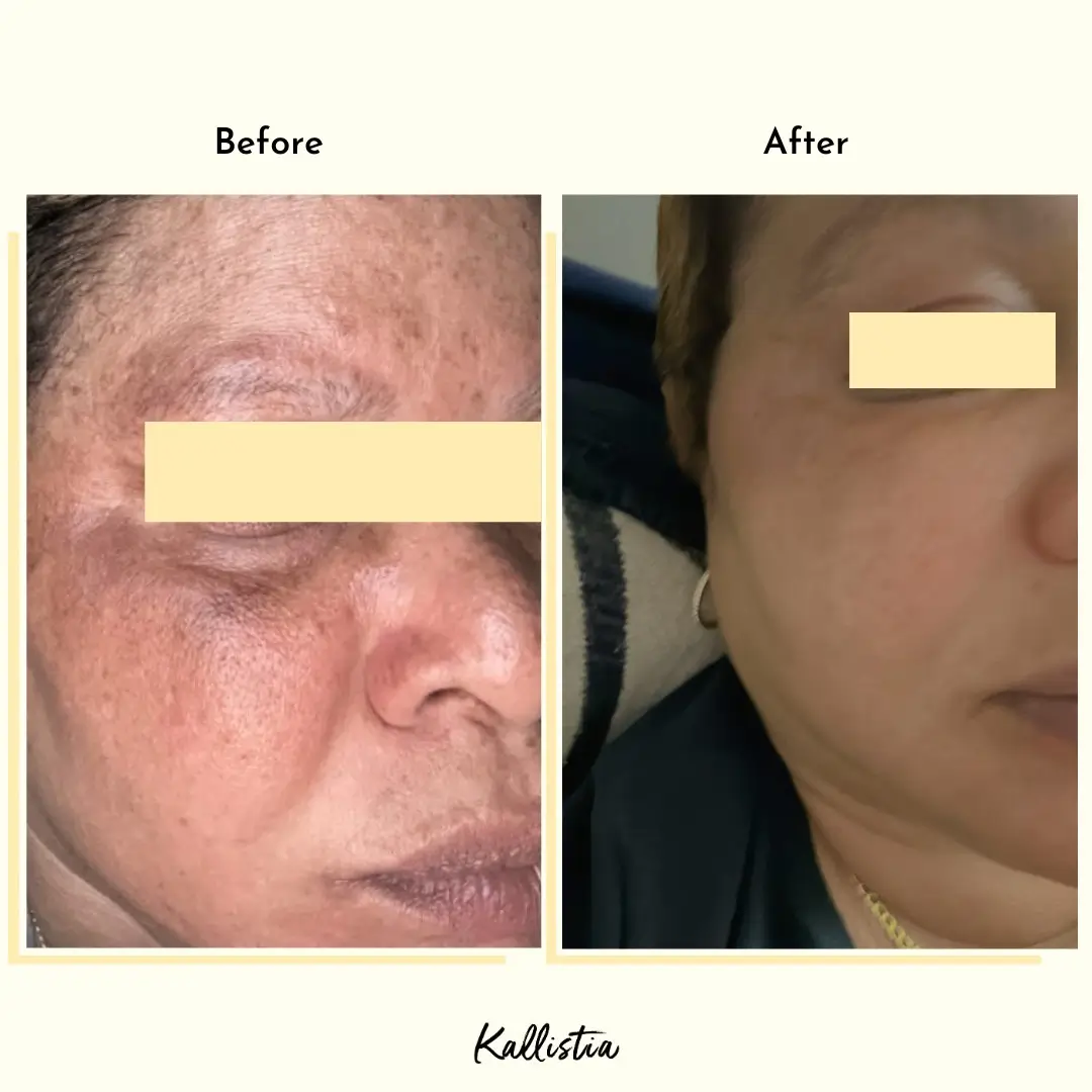 Heather — Melasma — after 3 weeks — before and after