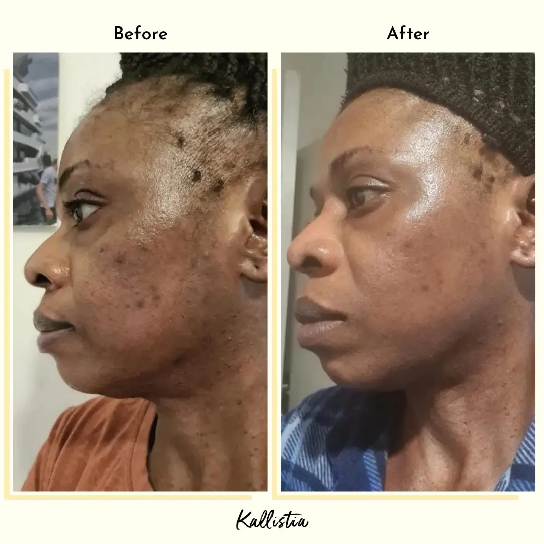 Marsha — Acne — after 4 weeks — before and after